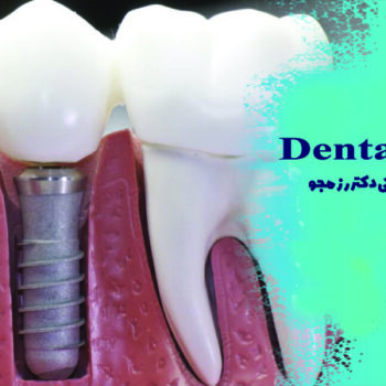 ایمپلنت دندان اصفهان