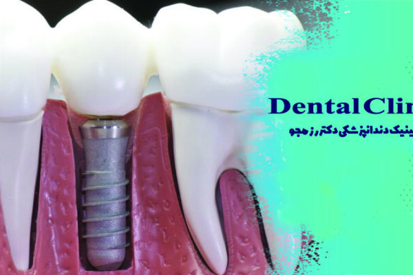 ایمپلنت دندان اصفهان