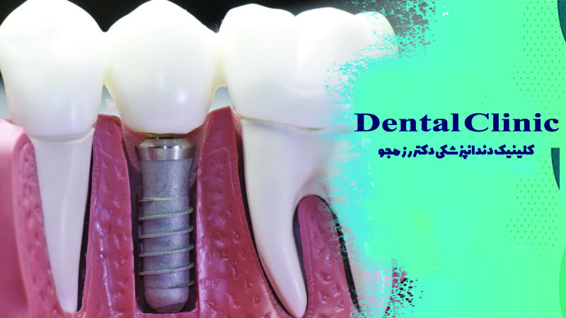 ایمپلنت دندان اصفهان