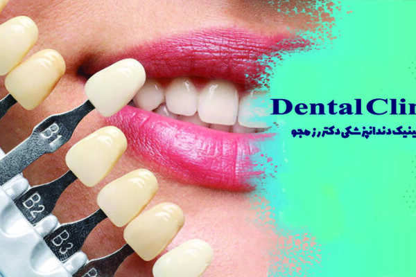 لمینت دندان در اصفهان