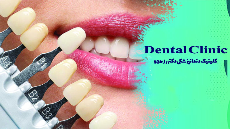 لمینت دندان در اصفهان