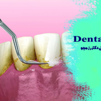 جرمگیری دندان در اصفهان