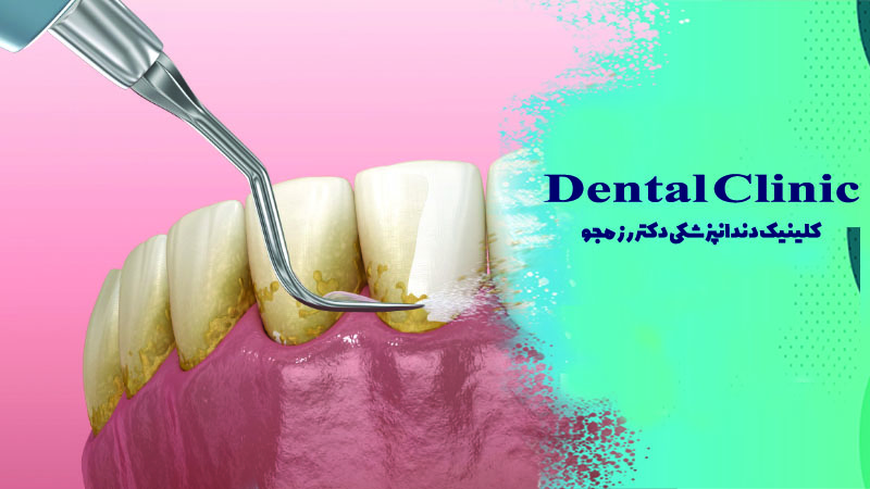 جرمگیری دندان در اصفهان