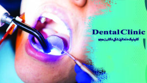 کامپوزیت دندان