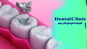 ترمیم های آمالگام یا کامپوزیت