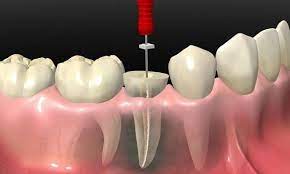  عصب کشی دندان