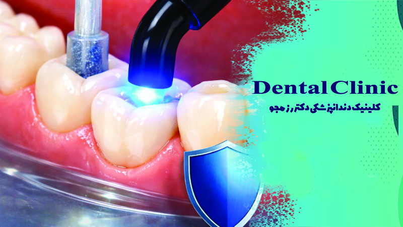 کامپوزیت دندان