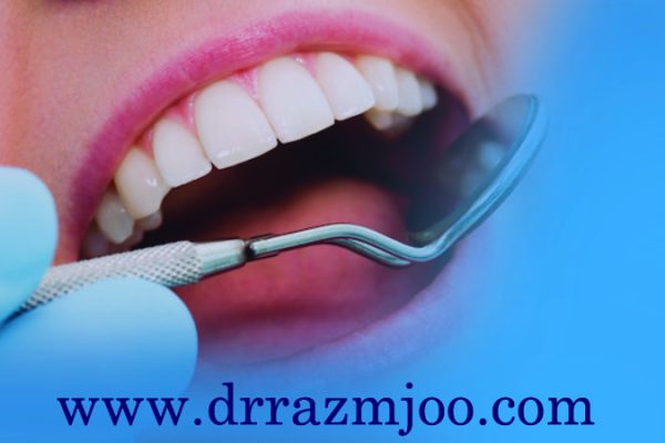 نانوکامپوزیت دندان چیست؟