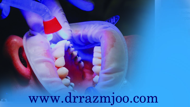 کامپوزیت دندان و روش های افزایش مقاومت دندان