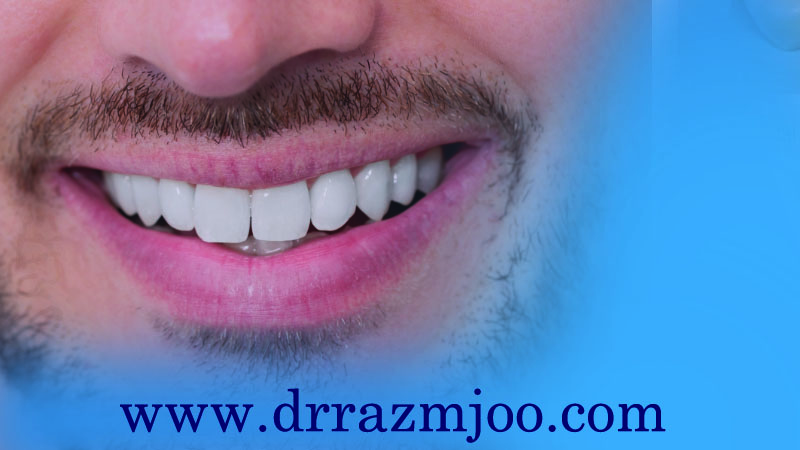 استفاده از کامپوزیت دندان در ترمیم دندان های جلو