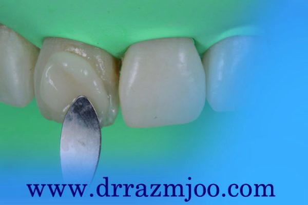 اصول طراحی و اجرای کامپوزیت دندان