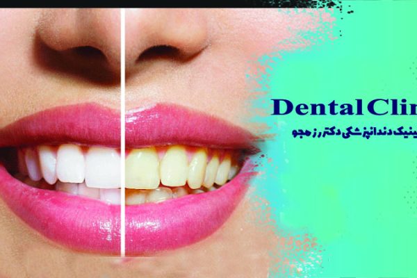 راهنمایی برای انتخاب بهترین روش بلیچینگ دندان