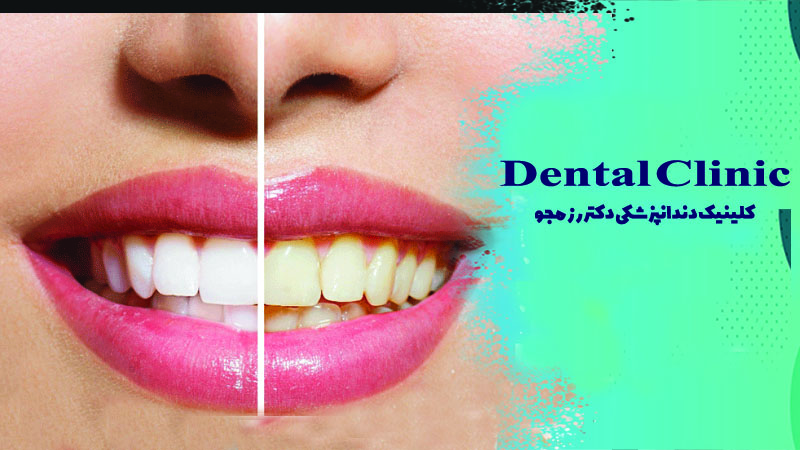 راهنمایی برای انتخاب بهترین روش بلیچینگ دندان