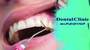 لمینت و درمان پیوره