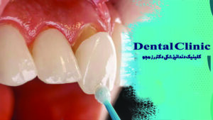 رفع شکستگی دندان با لمینت