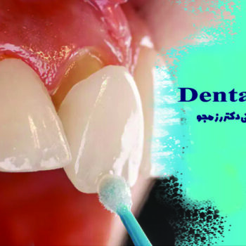 رفع شکستگی دندان با لمینت