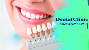 فواید استفاده از لمینت دندان