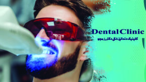 تفاوت بلیچینگ مطب و خانگی