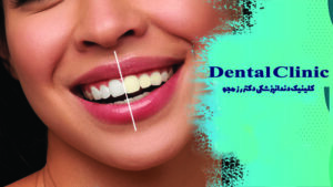 بلیچینگ دندان و تاثیرات آن بر افزایش روشنایی دندان ها