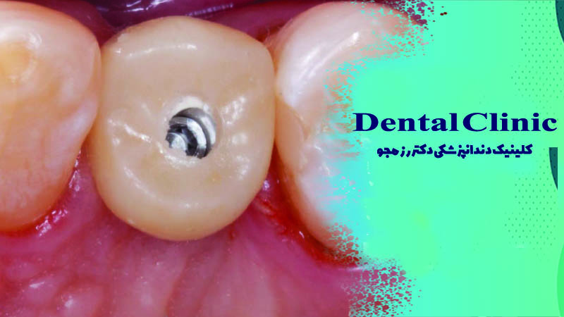 گذاشتن پین در دندان عصب کشی