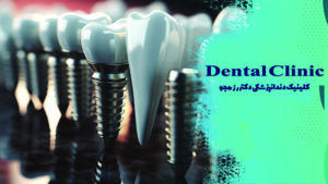 گرانترین نوع ایمپلنت