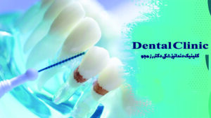 گیر غذایی پس از عمل دندان عصب کشی