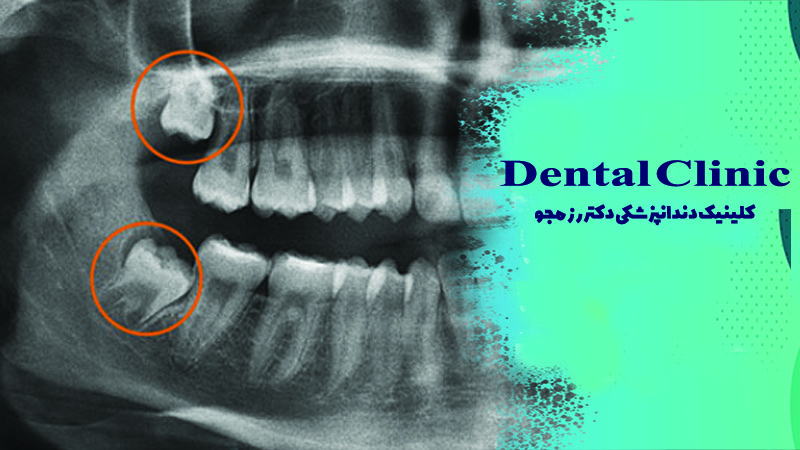 کشیدن یا ترمیم دندان عقل