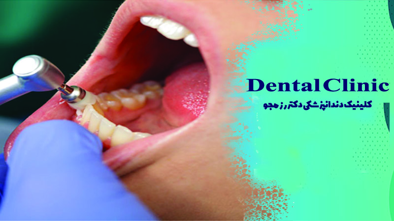 کانتورینگ دندان چیست
