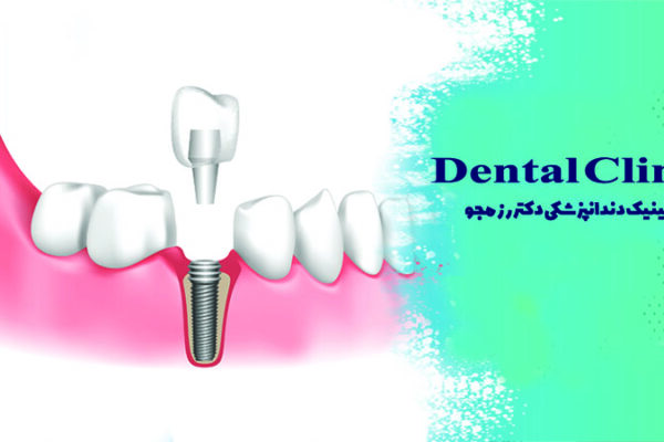 کاشت ایمپلنت چند مرحله دارد