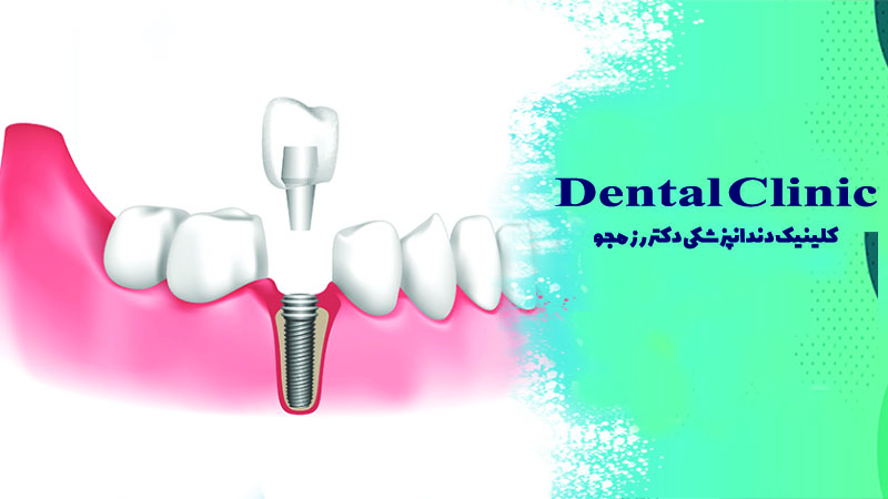 کاشت ایمپلنت چند مرحله دارد