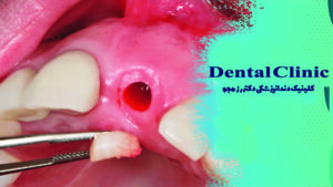 کاشت ایمپلنت به روش پانچ