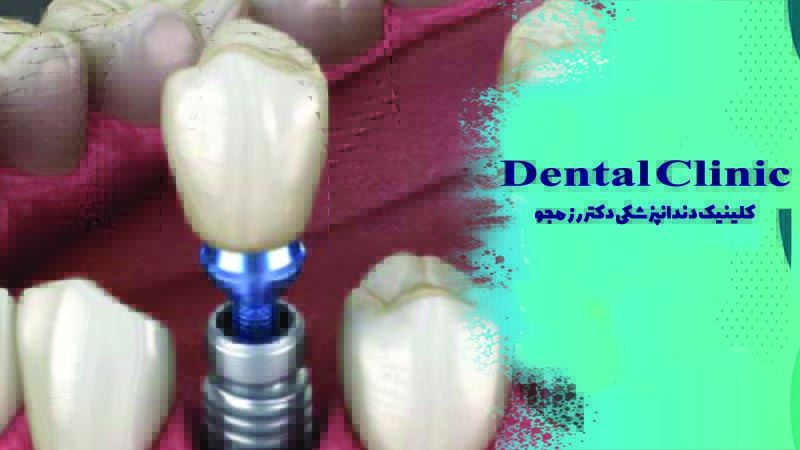 چگونگی ایمپلنت دندان