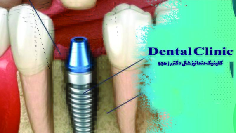 چند نوع کاشت دندان وجود دارد