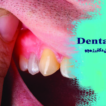 چرک کردن دندان