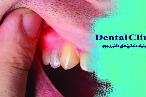 چرک کردن دندان