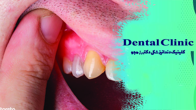 چرک کردن دندان