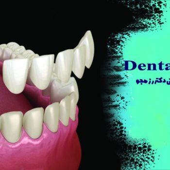 راهنمای چسباندن روکش دندان