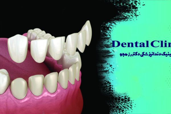 راهنمای چسباندن روکش دندان