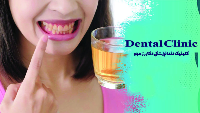 تأثیر مصرف چای بر ایمپلنت دندان