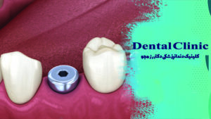 پیچ موقت ایمپلنت دندان