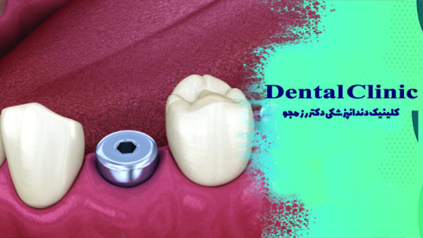 پیچ موقت ایمپلنت دندان