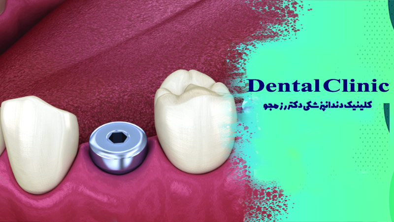 پیچ موقت ایمپلنت دندان