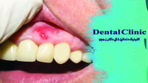 مقابله با چرک لثه