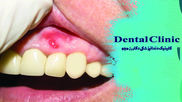 مقابله با چرک لثه