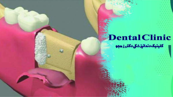 پیوند استخوان لگن به فک