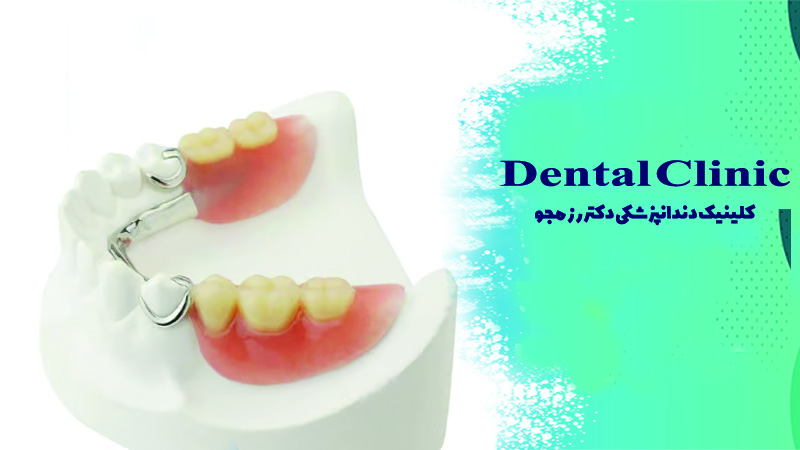 پارسیل کروم کبالت