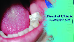 پانسمان دندان