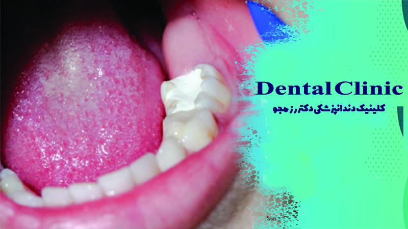 پانسمان دندان