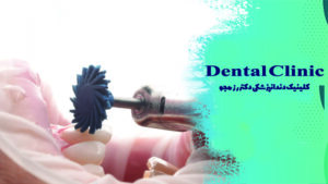 پالیش کامپوزیت دندان