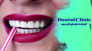 ونیر کامپوزیت چیست